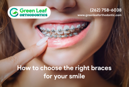 How to choose the right braces for your smile?