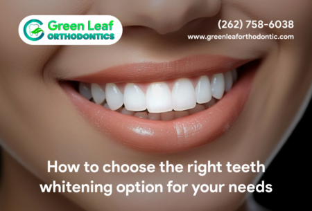 How to choose the right teeth whitening option for your needs