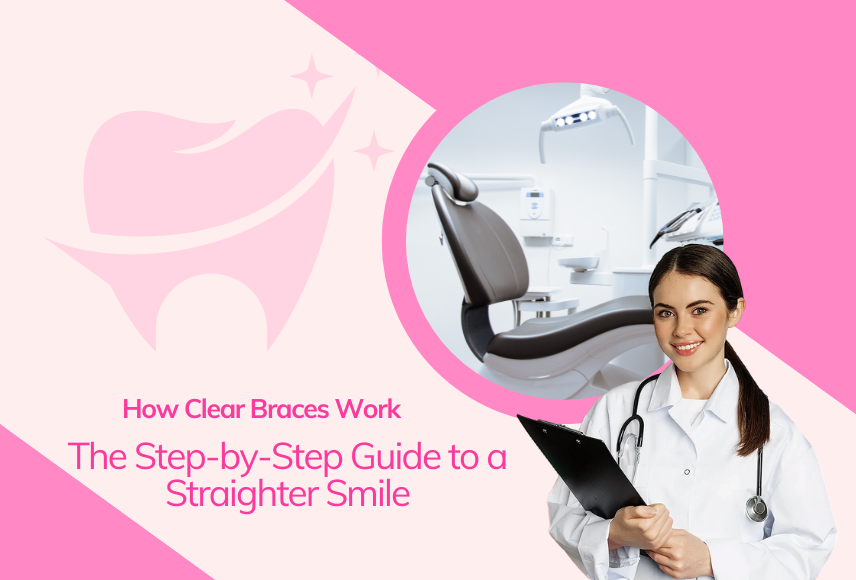 How Clear Braces Work: The Step-by-Step Guide to a Straighter Smile